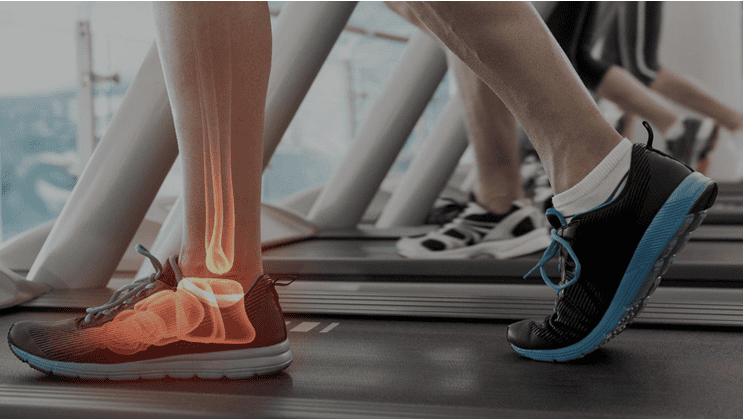Runners on treadmills with the ankle bones and tendons illustrated over one leg